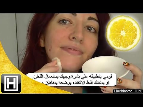 وصفة طبيعية تخلصك من حب الشباب نهائيًا