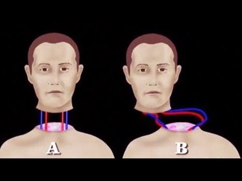 ماذا سيحدث إذا تم نقل رأسك إلى جسد جديد