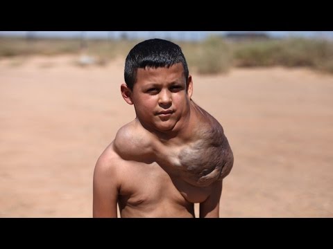 boy with neck growth to get lifechanging surgery